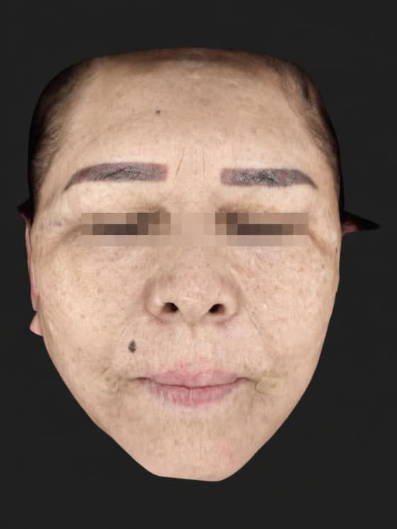 정면 시술 후 — 셀리닉의원에서 시술받은 동일 환자의 사진