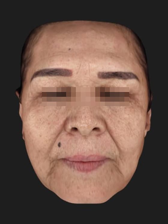 정면 시술 전 — 셀리닉의원에서 시술받은 동일 환자의 사진
